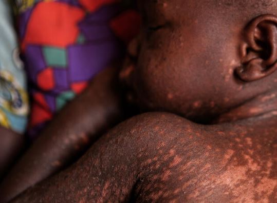 Measles outbreak in Cross River forces primary, secondary schools to vacate